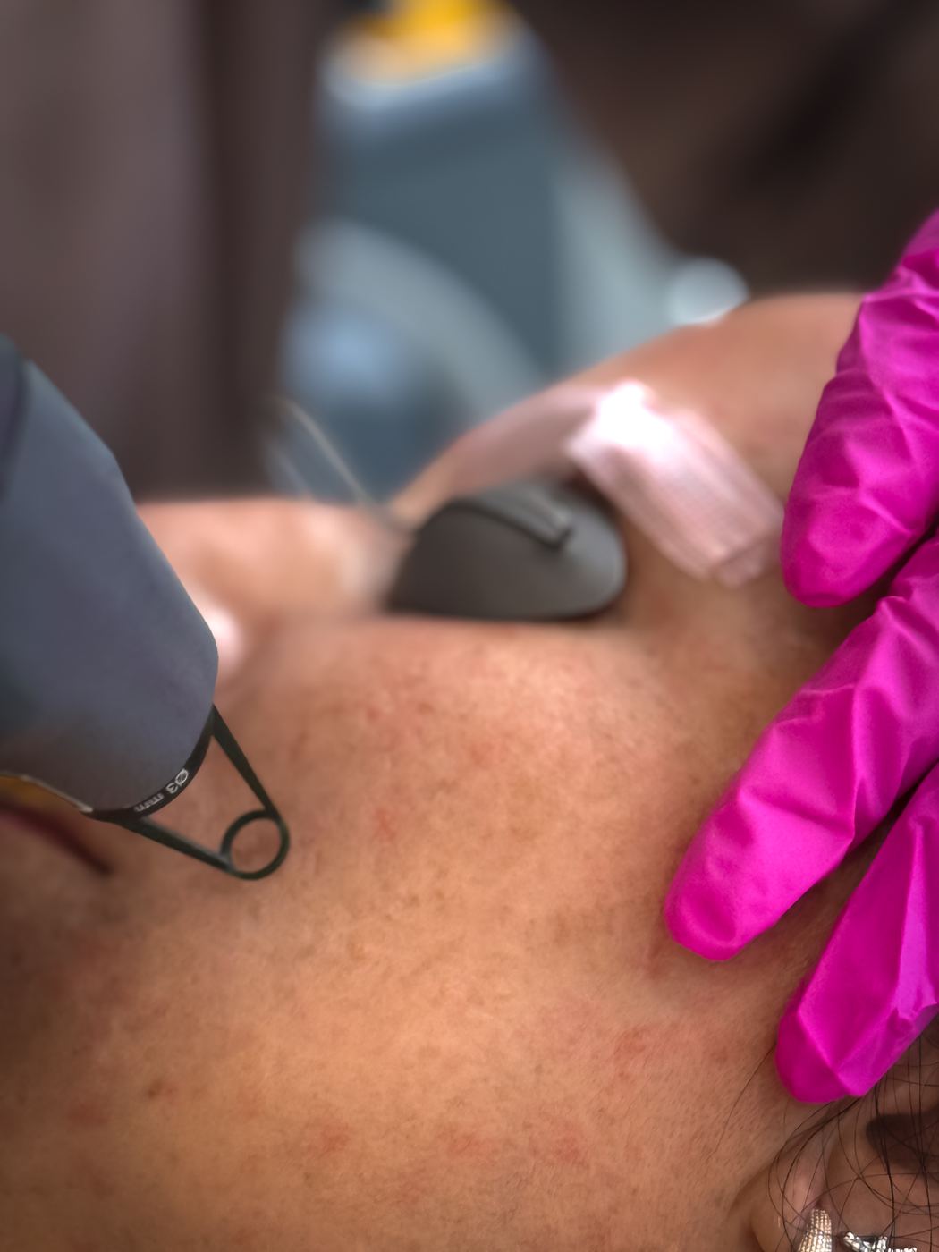 Aplicação de laser facial para pigmentação na Casa Moreira