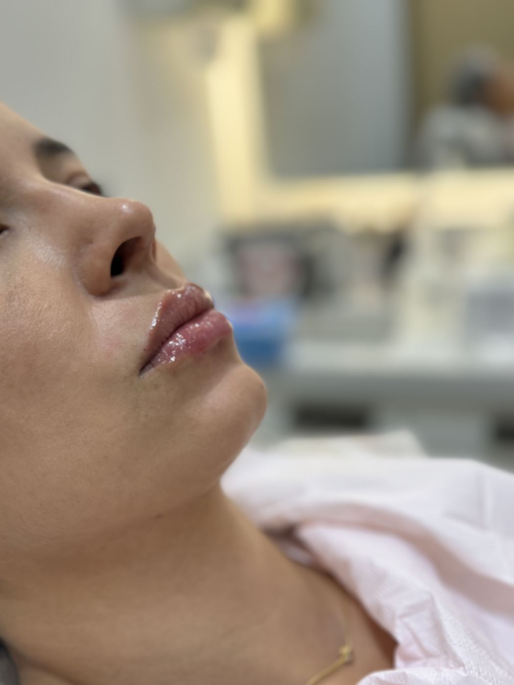 Preenchimento labial com ácido hialurônico na Casa Moreira