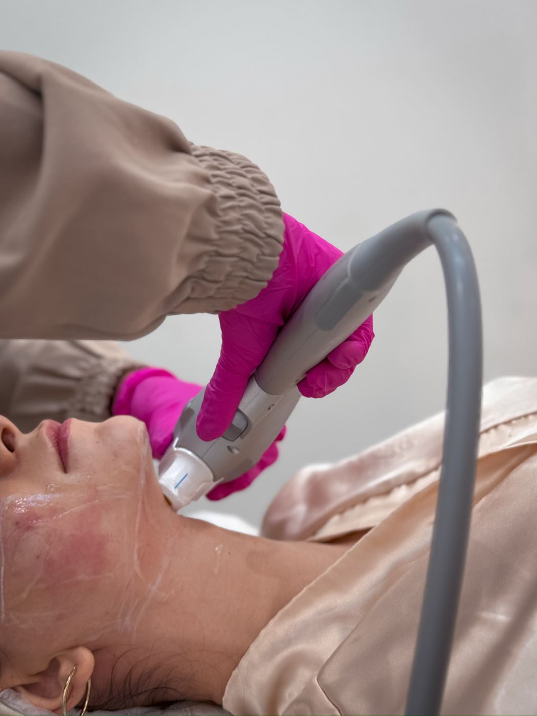 Ponteira do Ultraformer® em aplicação facial na Casa Moreira