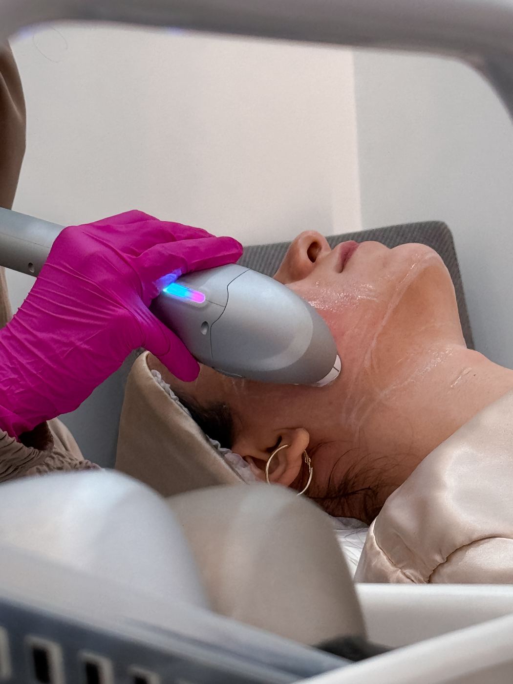 Sessão de Ultraformer® facial na Casa Moreira